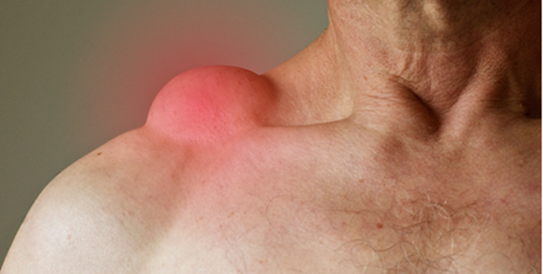 Lipoma lipoma treatment 1