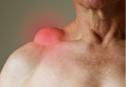 Lipoma lipoma treatment