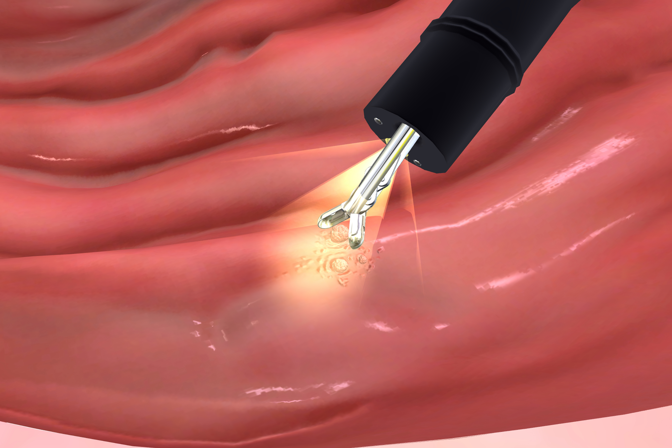 if abnormallooking tissue is spotted upper endoscopy biopsy can be performed 1